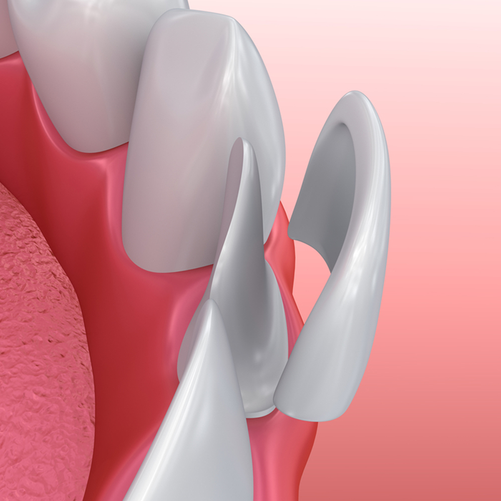 dental veneers