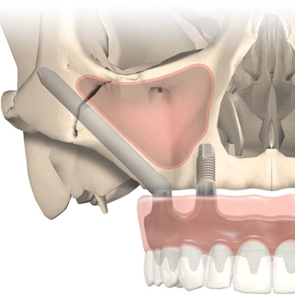 Zygomatic Dental Implants