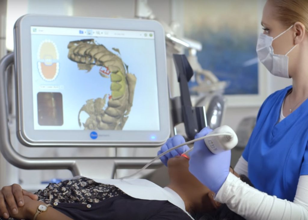 Itero intraoral scan in progress