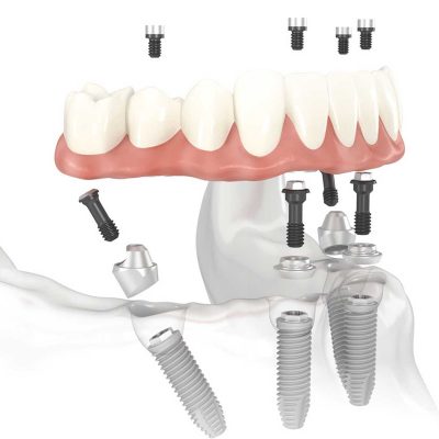All on 4 dental implants UK