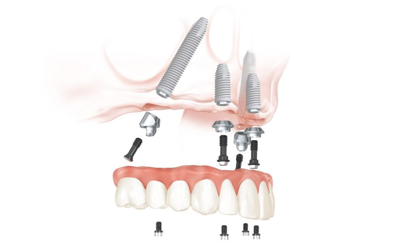 All-on-4 dental implant procedure upper