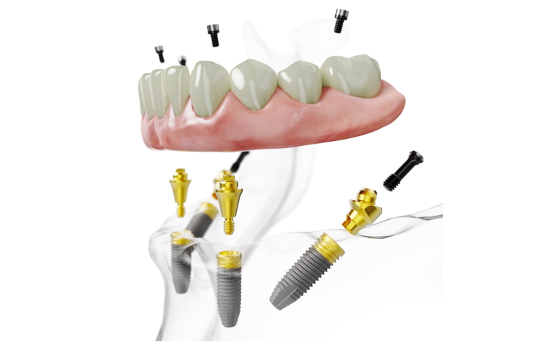 All-on-4 dental implants new