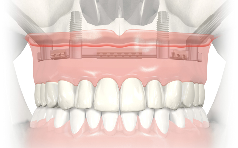 All-on-4 with zygomatic dental implants 2