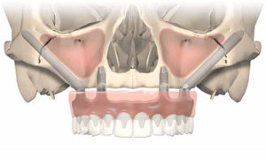 All-on-4 with zygomatic dental implants