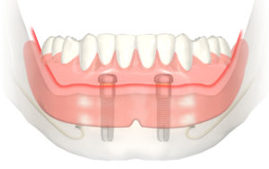 Implant retained denture