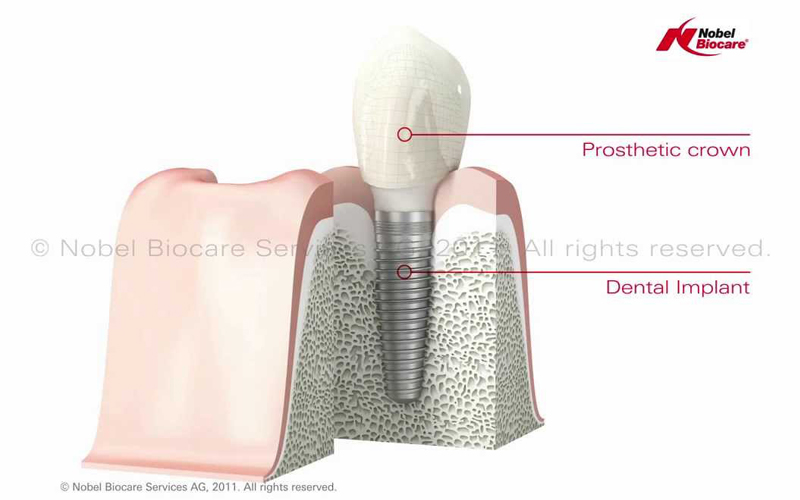 Single dental implant in jaw