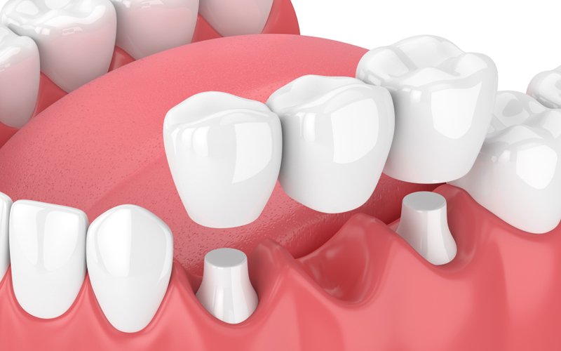dental implants retained bridge