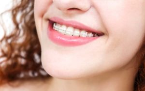 Girl wearing ceramic dental braces