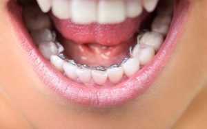 Girl wearing lingual dental braces 