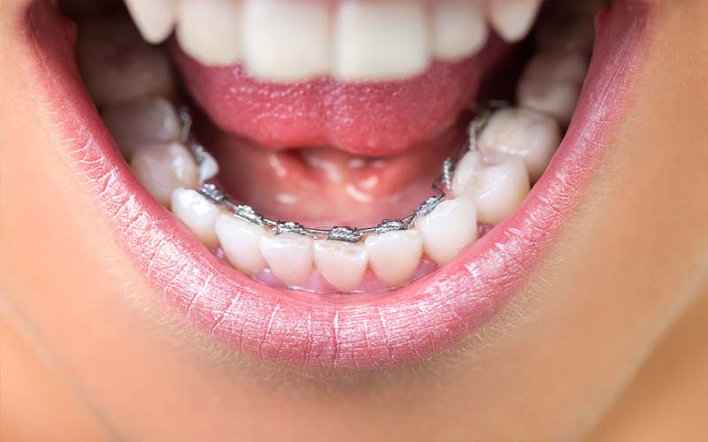 Girl wearing lingual dental braces