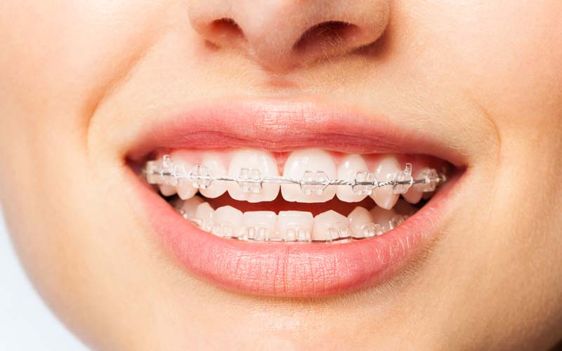 Ceramic braces closeup