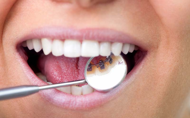 Lingual braces upper