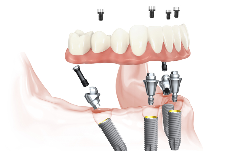 All-on-4 dental implants diagram