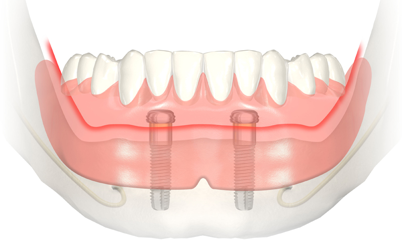 Dental implants retained denture