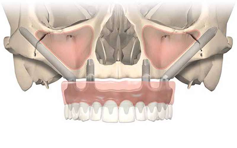 Zygomatic implants location of implants in jaw