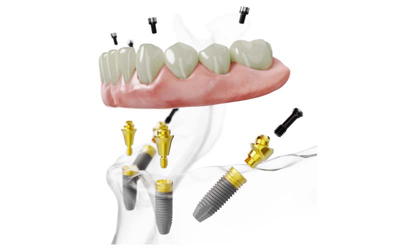All-on-4 dental implants bridge view 1