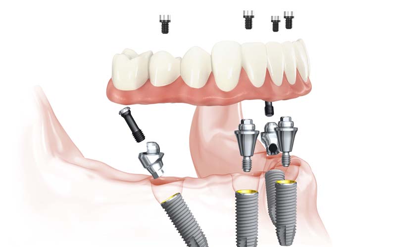 All-on-4 dental implants bridge view 2
