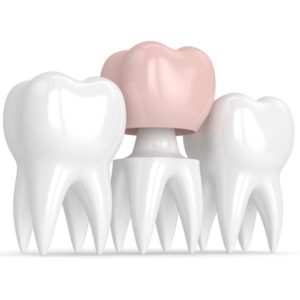 Dental Crowns Graphic