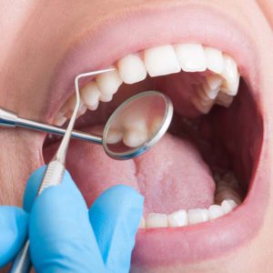 Invisible fillings via dental mirror