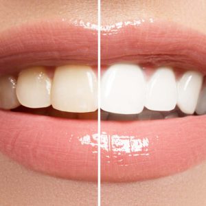 Teeth Whinteing Before and After