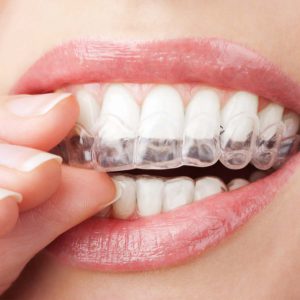 Teeth-Whitening-Trays 2