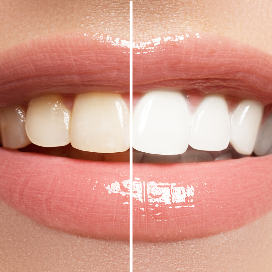 Teeth Whinteing Before and After Girl
