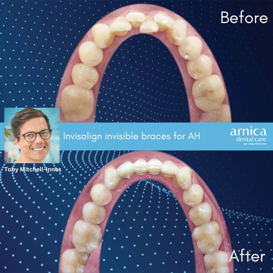 AH Invisalign Before and After - Website