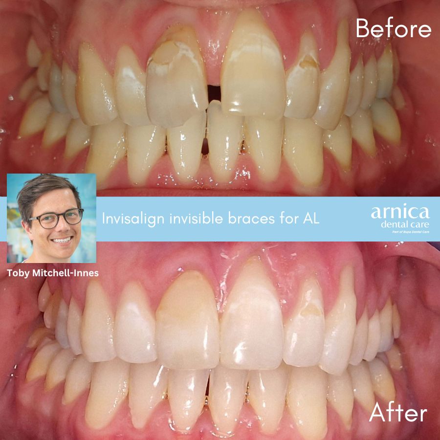 Andy Lewis Invisalign Before and After - Webpage