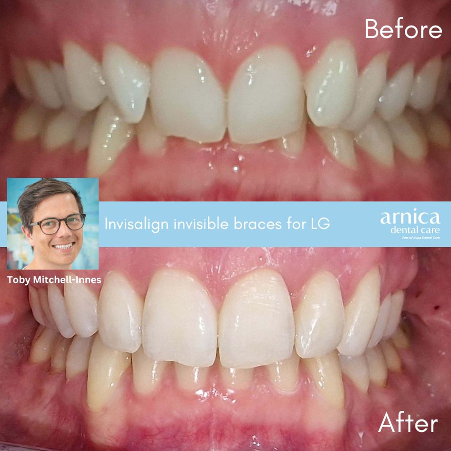 LG Invisalign Before and After - Webpage