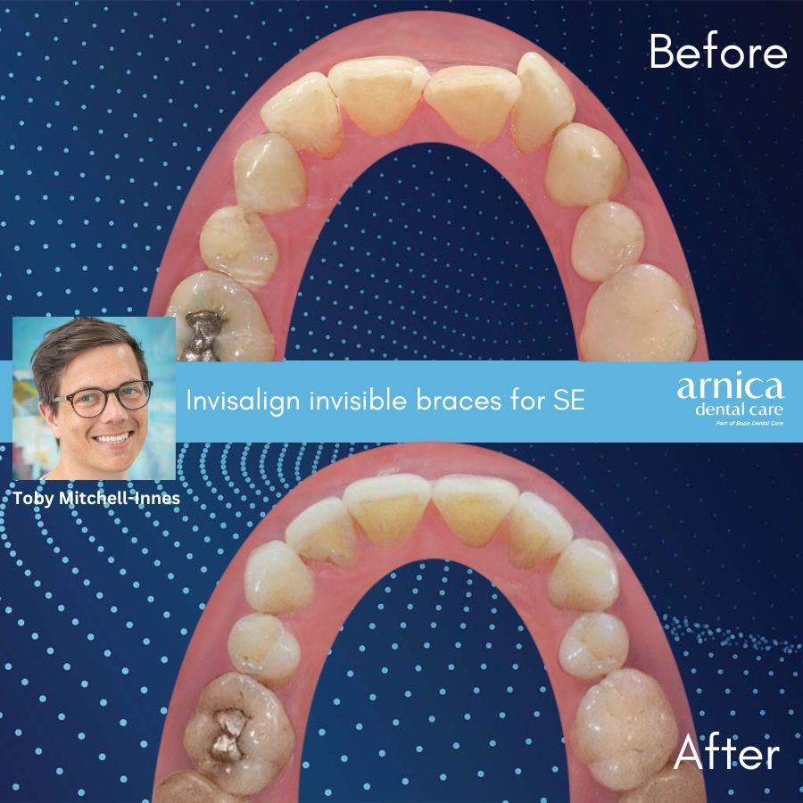 Stephen Egerton Invisalign Before and After - Website 2